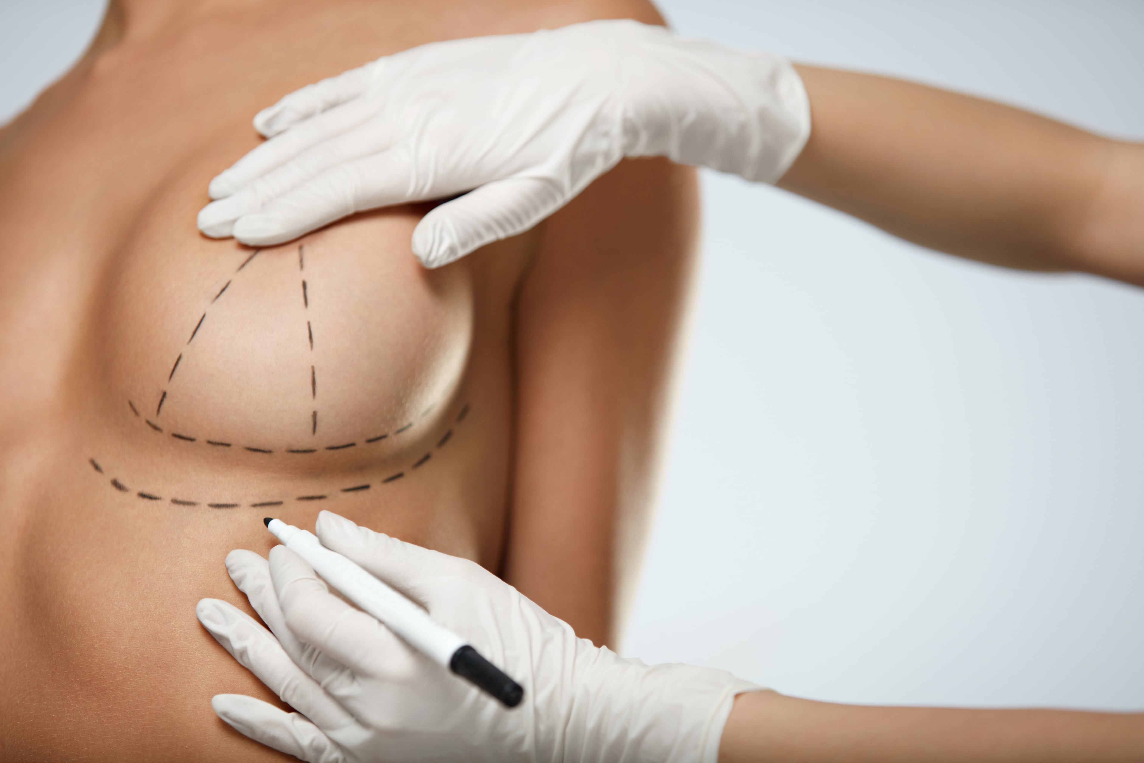 операция грудь женщин фото 85