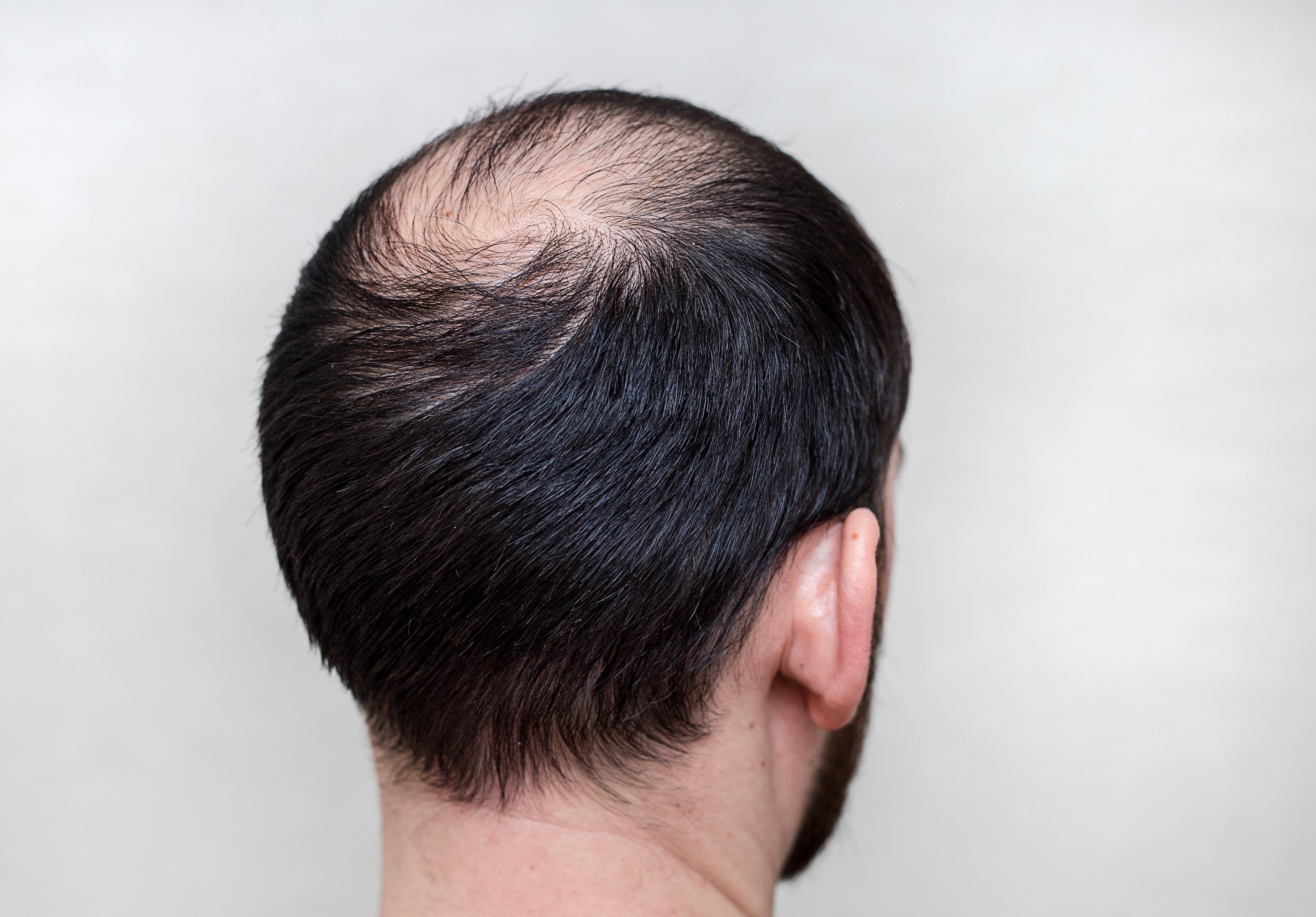 Выпадают волосы на затылке. Очаговая алопеция (alopecia Areata). Андрогенетическая алопеция у мужчин.